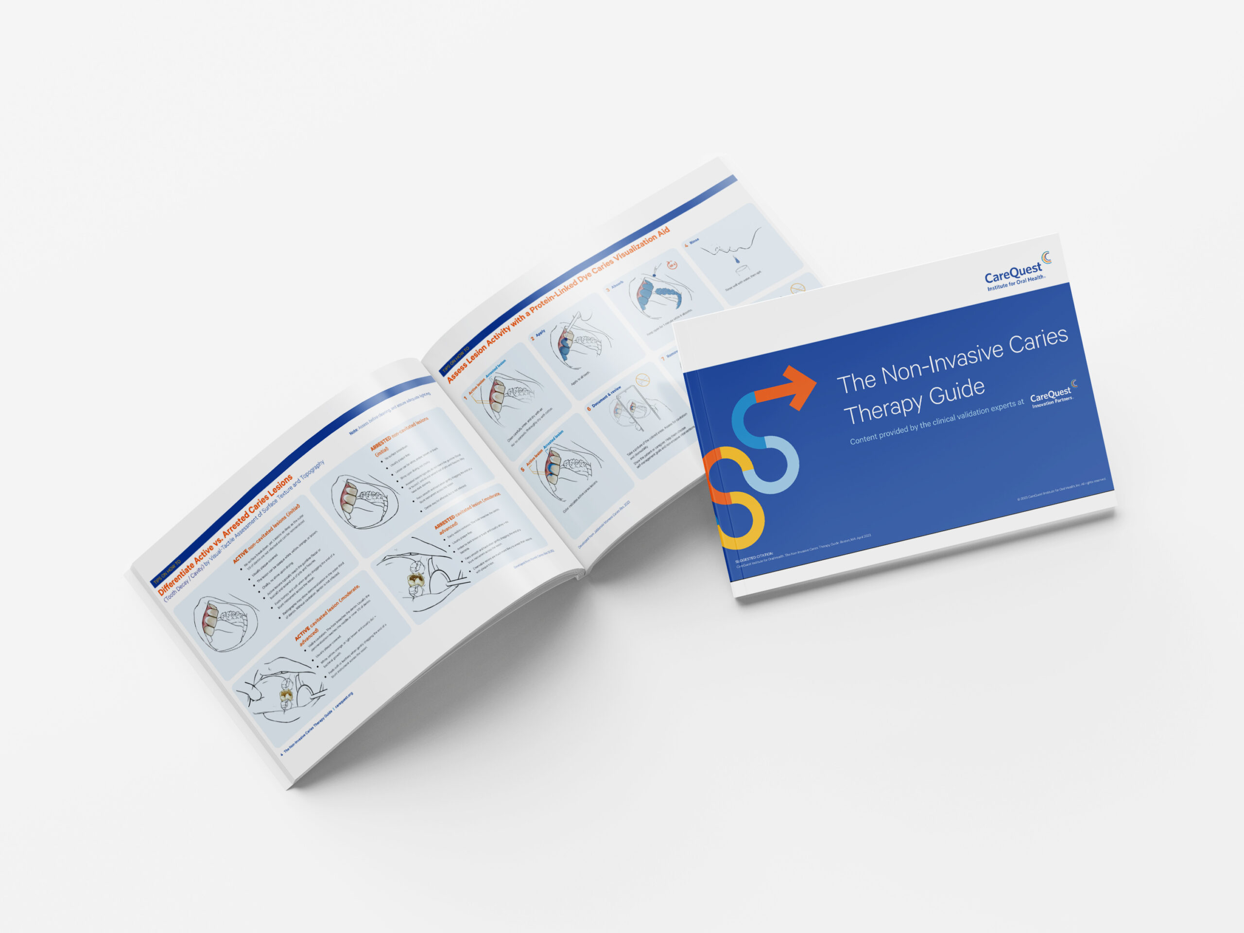 Non-Inavisve Caries Therapy Guide Non-Inavisve Caries Therapy Guide