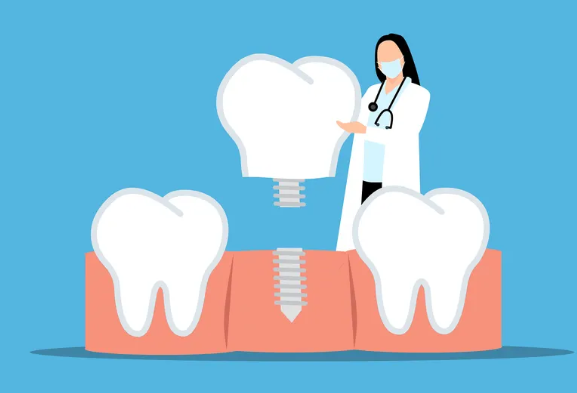 Dentist in mask showing a dental implant to replace a missing tooth on a blue background.